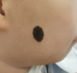 苏映军教授消“痣”不留痕 “色素痣”男孩一年后恢复容貌